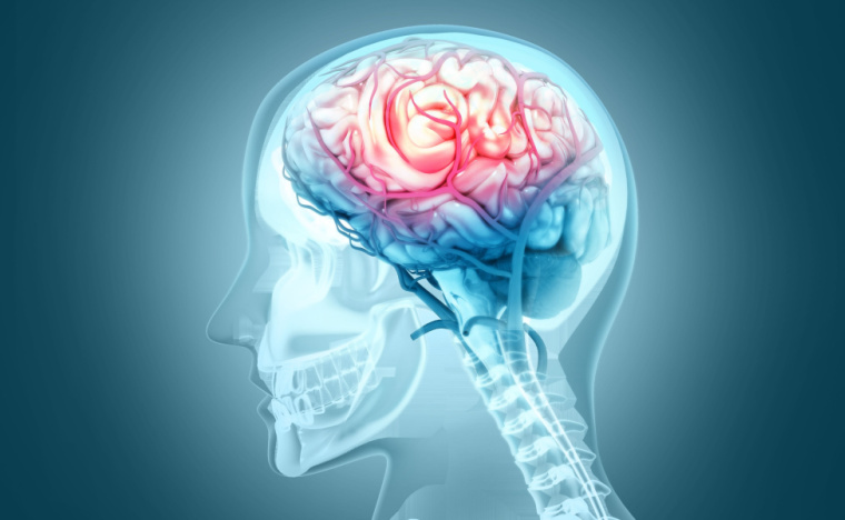 Señales de un ataque cerebrovascular (ACV) que no debes ignorar