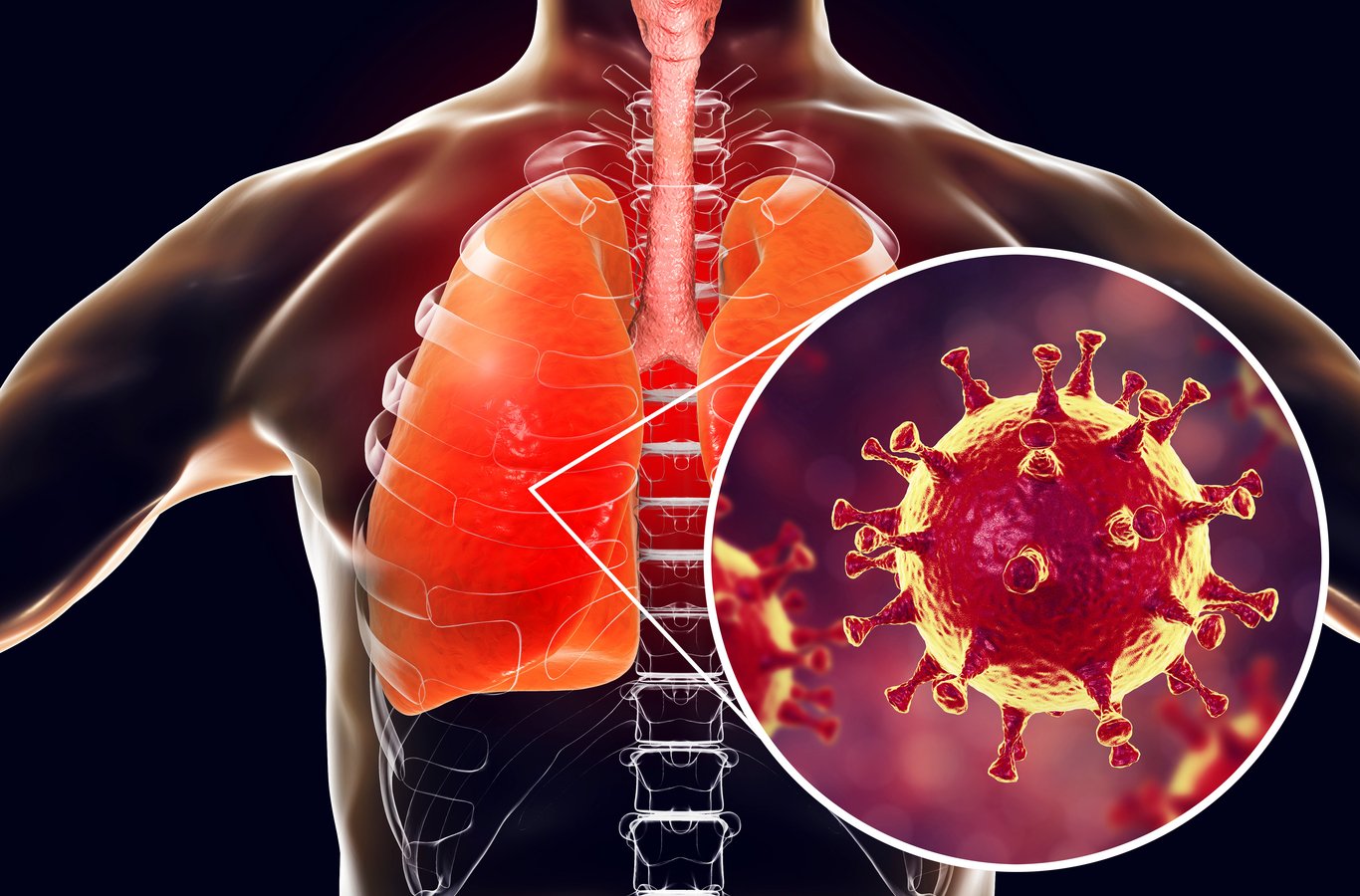 Coronavirus, el síndrome respiratorio que amenaza el 2020